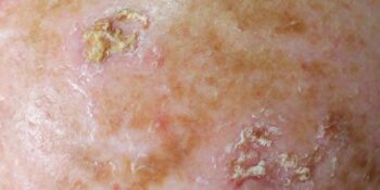 Actinic Keratosis / Sun Damage