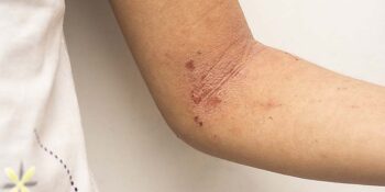 Atopic Eczema