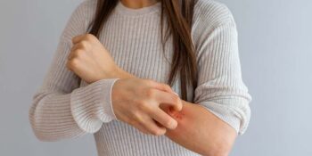 Common Skin Conditions