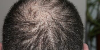 Hair Loss