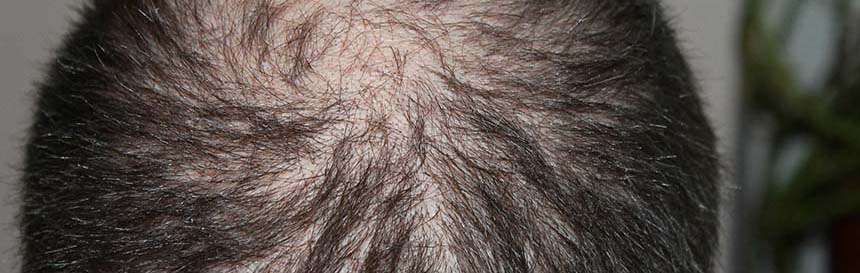 HairLoss2