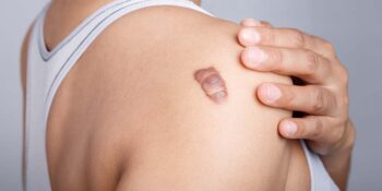 Keloids