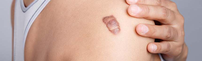 Keloids Scar