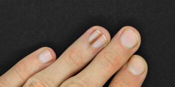 Nail Disorders