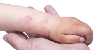 Paediatric Skin Conditions