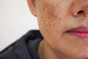 Pigmentation