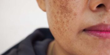 Pigmentation