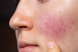 Rosacea