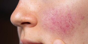 Rosacea