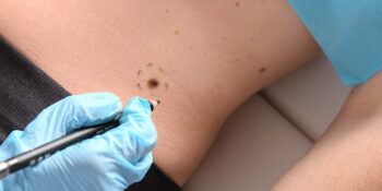 Skin Surgery