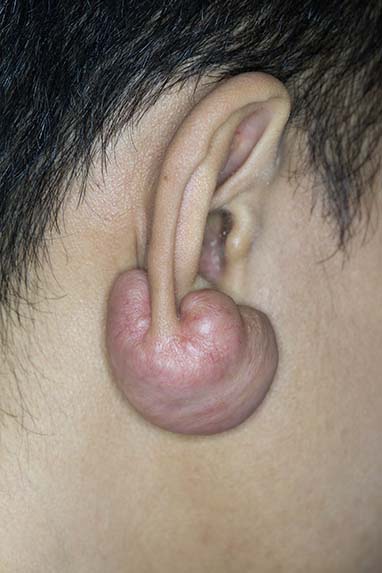 Keloids