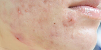 Acne And Acne Scars