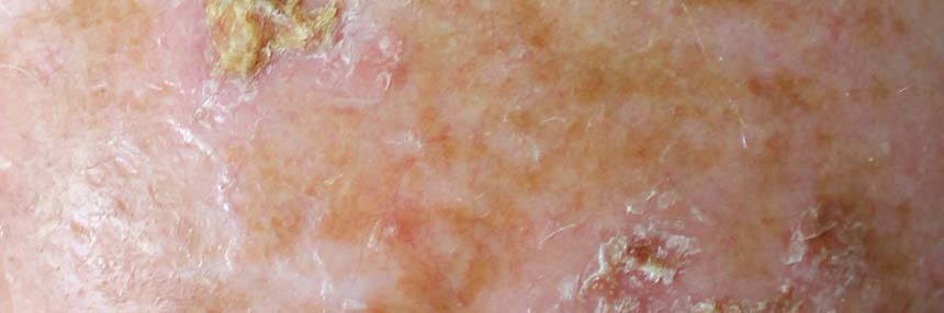 Common-Skin-Conditions Actinic keratosis sun damage