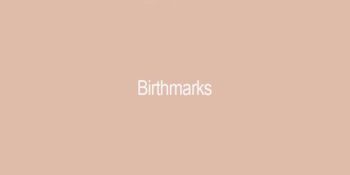 Birthmarks