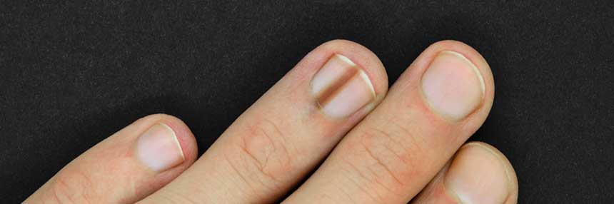  Common Skin Conditions Nail disorders