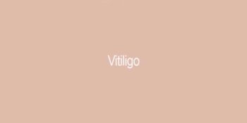 Vitiligo