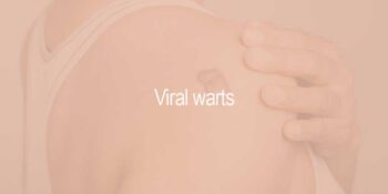 Viral Warts