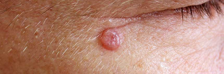 Skin Cancer
