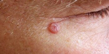 Skin Cancers
